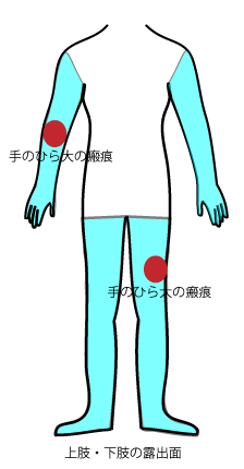 上肢・下肢の露出面の醜状