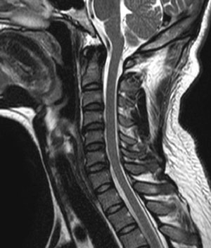 頚椎のMRI画像