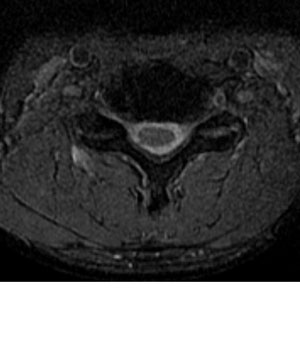 頚椎のMRI（水平断）