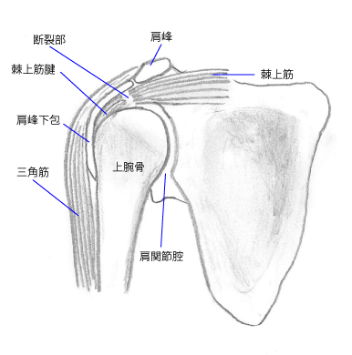 腱 板 損傷