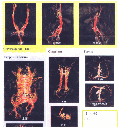 高次脳機能障害 拡散テンソルトラクトグラフィー画像